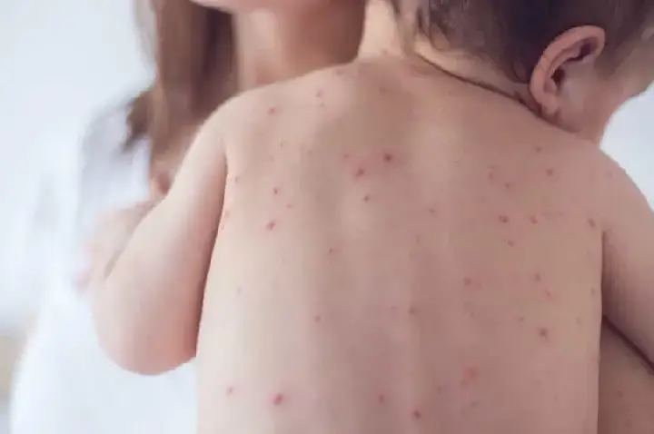SP confirma 2 novos casos de sarampo e estado soma 7 infecções em 2026